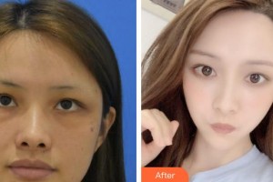 義烏視光眼科醫(yī)院賈金秀整形價格表附激光去眼袋案例展示