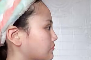 沈陽杏林美容整形醫(yī)院朱石江顴骨顴弓手術(shù)果咋樣？附果圖