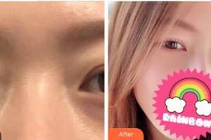 滕州時光醫(yī)療美容門診部歐陽天祥整形價格表附內(nèi)切祛眼袋案例展示