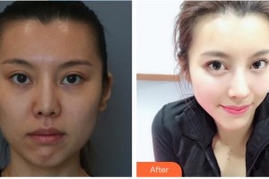 滕州美界醫(yī)療整形診所谷曉紅整形價格表附鼻部綜合案例展示