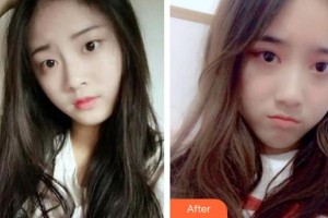 滕州市財貿(mào)醫(yī)院眼科孫友鵬整形價格表附眼部綜合案例展示