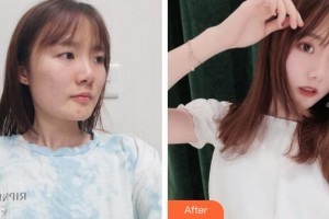 滕州美界醫(yī)療整形診所易彬整形價格表附切開雙眼皮案例展示