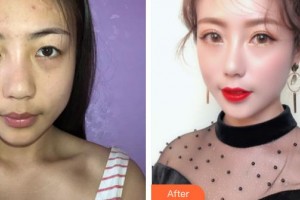 解放軍總醫(yī)院第一附屬醫(yī)院燒傷整形科柴家科整形價格表附切開雙眼皮案例展示