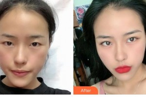 解放軍總醫(yī)院第一附屬醫(yī)院燒傷整形科京薩整形價格表附切開雙眼皮案例展示