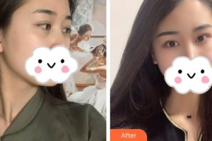 解放軍411醫(yī)院激光整形中心趙燁德整形價格表附內(nèi)切祛眼袋案例展示