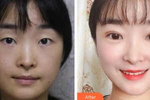 中國人民解放軍總政門診部醫(yī)學美容中心王世勇整形價格表附切開雙眼皮案例展示