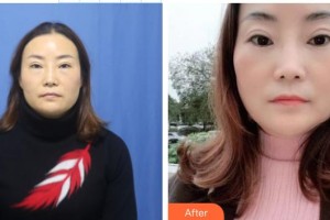 中國人民解放軍第四五七醫(yī)院陸海整形價格表附激光去眼袋案例展示