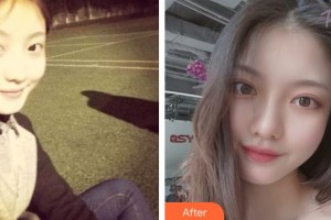 解放軍總裝備部后勤部醫(yī)學整形中心張殿祥整形價格表附開內(nèi)眼角案例展示