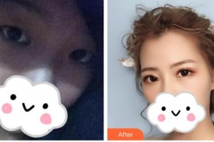 解放軍四五四醫(yī)院整形美容中心周吉玲整形價格表附眼部綜合案例展示