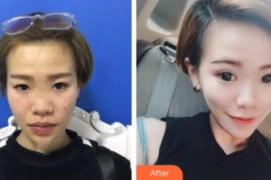 解放軍總裝備部后勤部醫(yī)學整形中心陳比較好的整形價格表附眼部綜合案例展示