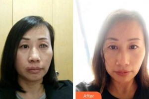 解放軍四五四醫(yī)院整形美容中心嚴(yán)道金整形價格表附熱拉提案例展示