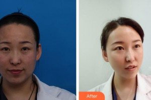 解放軍421醫(yī)院整形美容中心潘曉海整形價格表抗衰老緊膚埋線提升案例展示