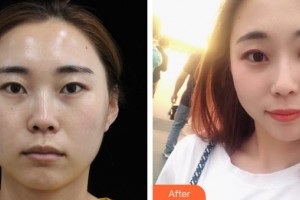 解放軍421醫(yī)院整形美容中心蒙喜永整形價格表附熱瑪吉案例展示