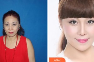 解放軍總裝備部后勤部醫(yī)學整形中心鐘華整形價格表附埋線提升案例展示