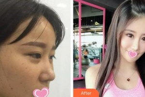 解放軍總裝備部后勤部醫(yī)學(xué)整形中心馬長生整形價格表附激光美膚激光案例展示