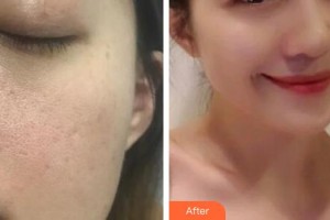 解放軍總醫(yī)院第一附屬醫(yī)院燒傷整形科梁黎明整形價格表附埋線提升案例展示