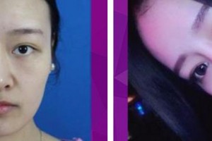 解放軍總醫(yī)院第一附屬醫(yī)院燒傷整形科賈赤宇整形價格表附鼻部綜合案例展示