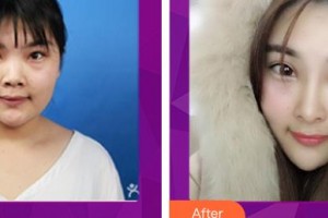 解放軍總醫(yī)院第一附屬醫(yī)院燒傷整形科李利根整形價格表附鼻部綜合案例展示