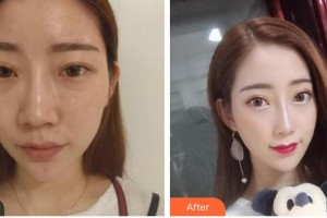 解放軍第三〇三醫(yī)院燒傷整形美容外科謝方明整形價格表附鼻部綜合案例展示