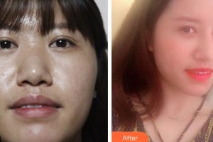 解放軍總醫(yī)院第一附屬醫(yī)院燒傷整形科楊紅明整形價格表附鼻部綜合案例展示