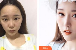 解放軍總醫(yī)院第一附屬醫(yī)院燒傷整形科宋慧鋒整形價格表附假體隆鼻案例展示