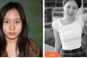 解放軍第三〇三醫(yī)院燒傷整形美容外科黃震亞整形價格表附鼻部綜合案例展示