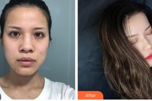 解放軍第三〇三醫(yī)院燒傷整形美容外科黃卓正整形價格表附鼻部綜合案例展示