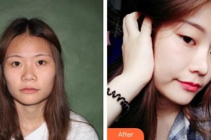 解放軍第三〇三醫(yī)院燒傷整形美容外科陳岳整形價格表附鼻部綜合案例展示