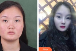 解放軍第一五八醫(yī)院整形美容中心刁樹信整形價格表附鼻部綜合案例展示