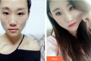 解放軍總醫(yī)院第一附屬醫(yī)院燒傷整形科申傳安整形價格表附硅膠隆鼻案例展示