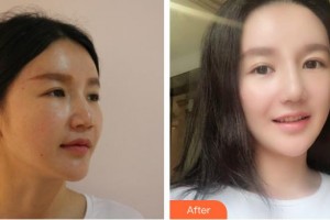 中國人民解放軍第一六三醫(yī)院整形美容中心劉麗芳整形價格表附假體隆鼻案例展示