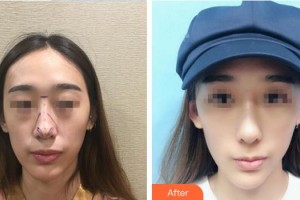 中國人民解放軍251醫(yī)院整形美容科全娟整形價格表附鼻部綜合案例展示