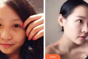 中國人民解放軍第一六三醫(yī)院整形美容中心董海燕整形價格表附鼻部綜合案例展示