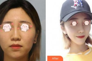 解放軍第159醫(yī)院燒傷整形美容康復中心林國安整形價格表附鼻部綜合案例展示