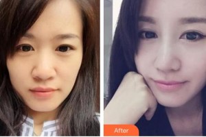 中國(guó)人民解放軍第一六三醫(yī)院整形美容中心吳丙整形價(jià)格表附硅膠隆鼻案例展示