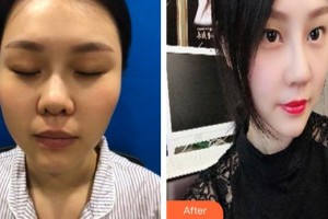 解放軍第159醫(yī)院燒傷整形美容康復(fù)中心袁仕安整形價(jià)格表附肋軟骨隆鼻案例展示