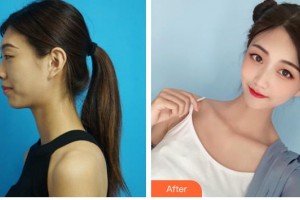 解放軍474醫(yī)院激光美容中心閆霜整形價(jià)格表附耳軟骨復(fù)合隆鼻案例展示