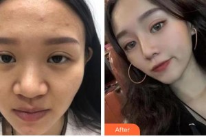 解放軍105醫(yī)院整形美容中心吳端整形價(jià)格表附鼻部綜合案例展示