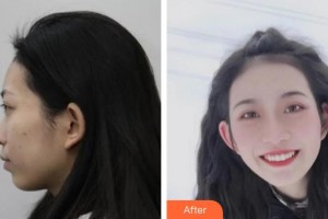 中國(guó)人民解放軍第100醫(yī)院整形美容中心武曉莉整形價(jià)格表附埋線提升案例展示