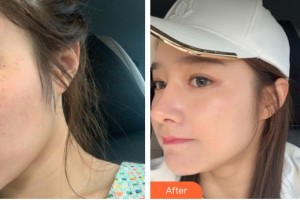 解放軍一八一醫(yī)院醫(yī)學(xué)整形美容科粟雪梅整形價(jià)格表附激光美膚激光案例展示