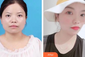 中國(guó)人民解放軍第100醫(yī)院整形美容中心孫守縣整形價(jià)格表附埋線提升案例展示