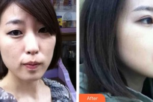 中國(guó)人民解放軍第100醫(yī)院整形美容中心林長(zhǎng)能整形價(jià)格表附埋線提升案例展示