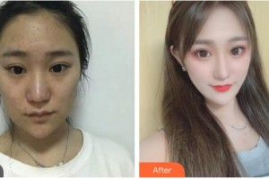 中國(guó)人民解放軍第四二一疤痕修復(fù)中心王廣浩整形價(jià)格表附埋線提升案例展示