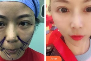 中國(guó)人民解放軍第455疤痕調(diào)節(jié)中心鐘曉珊整形價(jià)格表附埋線提升案例展示