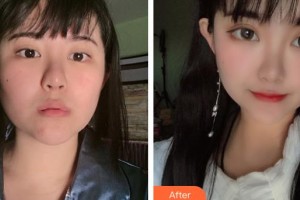 第四軍醫(yī)大學(xué)唐都醫(yī)院整形激光美容中心陳紹宗整形價(jià)格表附鼻翼縮小案例展示