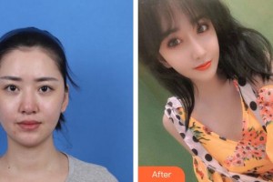 第四軍醫(yī)大學(xué)唐都醫(yī)院整形激光美容中心李躍軍整形價(jià)格表附鼻部綜合案例展示