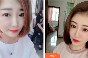 第四軍醫(yī)大學(xué)唐都醫(yī)院整形激光美容中心李望舟整形價(jià)格表附耳軟骨復(fù)合隆鼻案例展示