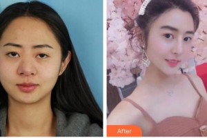 第四軍醫(yī)大學(xué)唐都醫(yī)院整形激光美容中心杜潔整形價(jià)格表附鼻部綜合案例展示