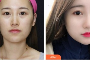 中國醫(yī)學(xué)科學(xué)院整形外科醫(yī)院莊洪興整形價(jià)格表附去痘印痘坑案例展示