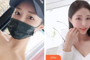 中國醫(yī)學(xué)科學(xué)院整形外科醫(yī)院趙振民整形價(jià)格表附光子嫩膚案例展示